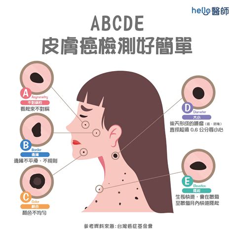 身體有痣|痣變大、痣多或長毛會變皮膚癌？認識痣的形成與原因